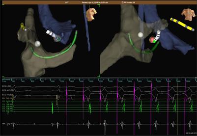 Transseptal Approach Versus Transaortic Approach for Catheter Ablation of Left-Sided Accessory Pathways in Children